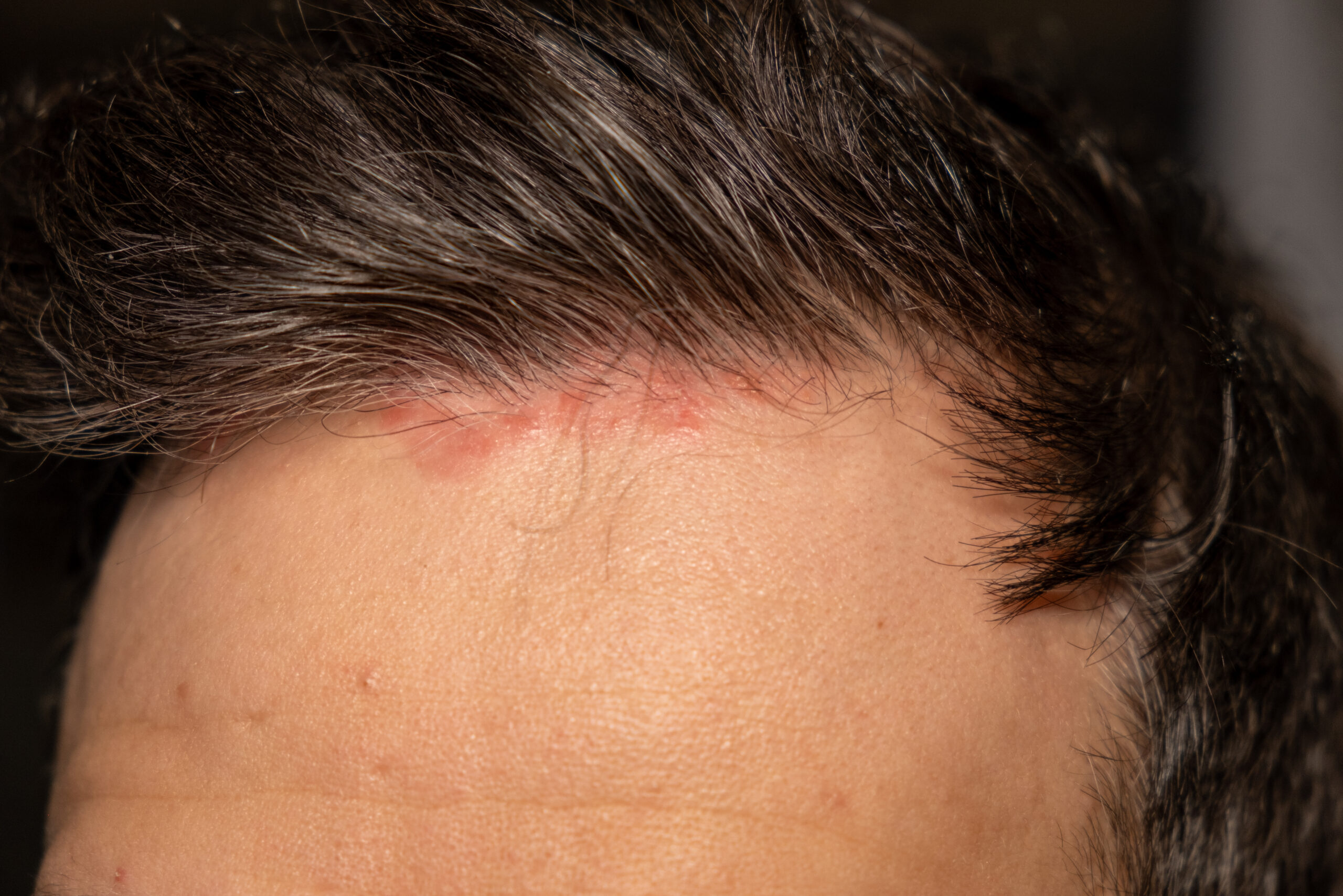 Redness and minor irritation along the hairline after undergoing an advanced ARTAS hair transplant procedure.