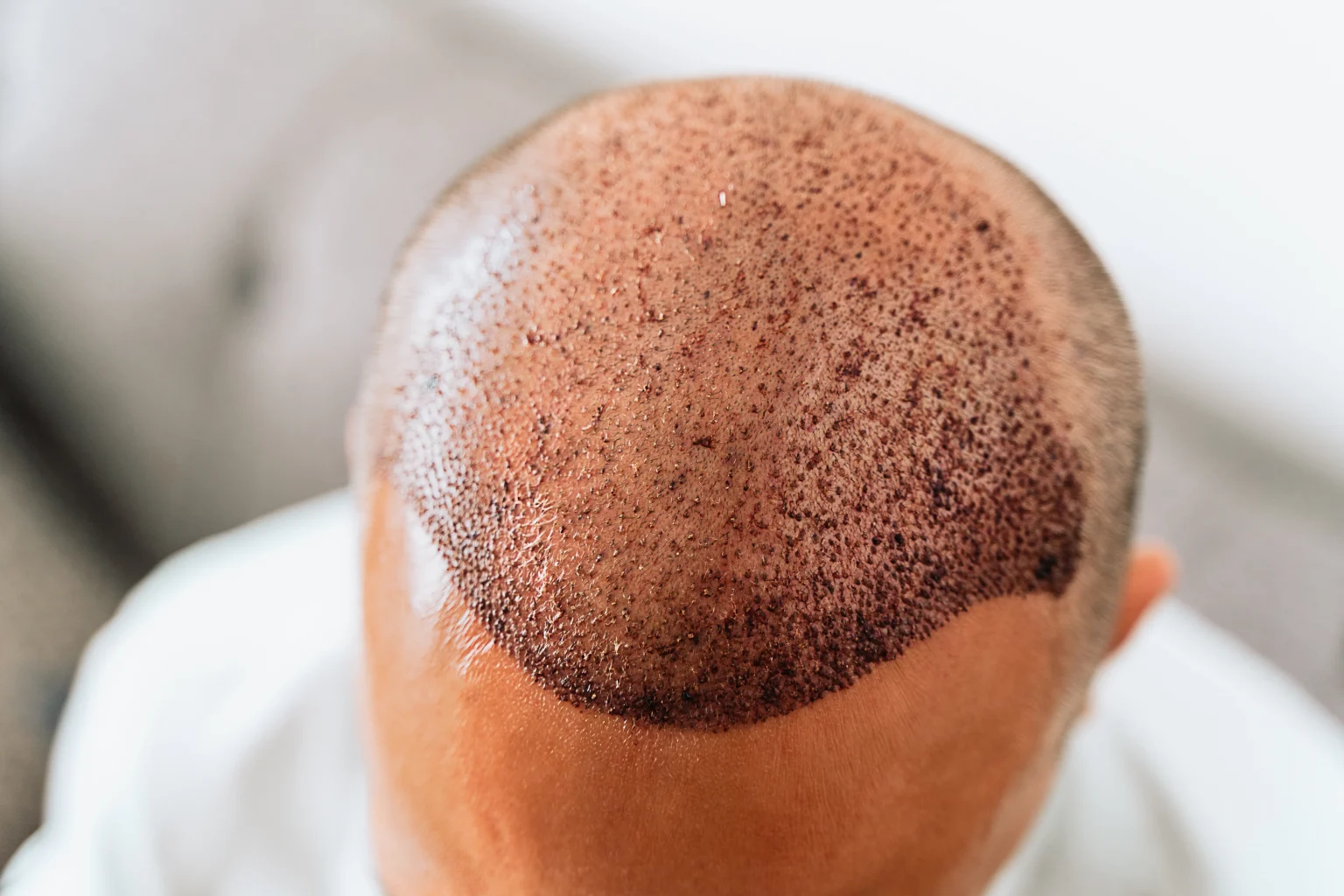 Best hair transplant Mexico 2026