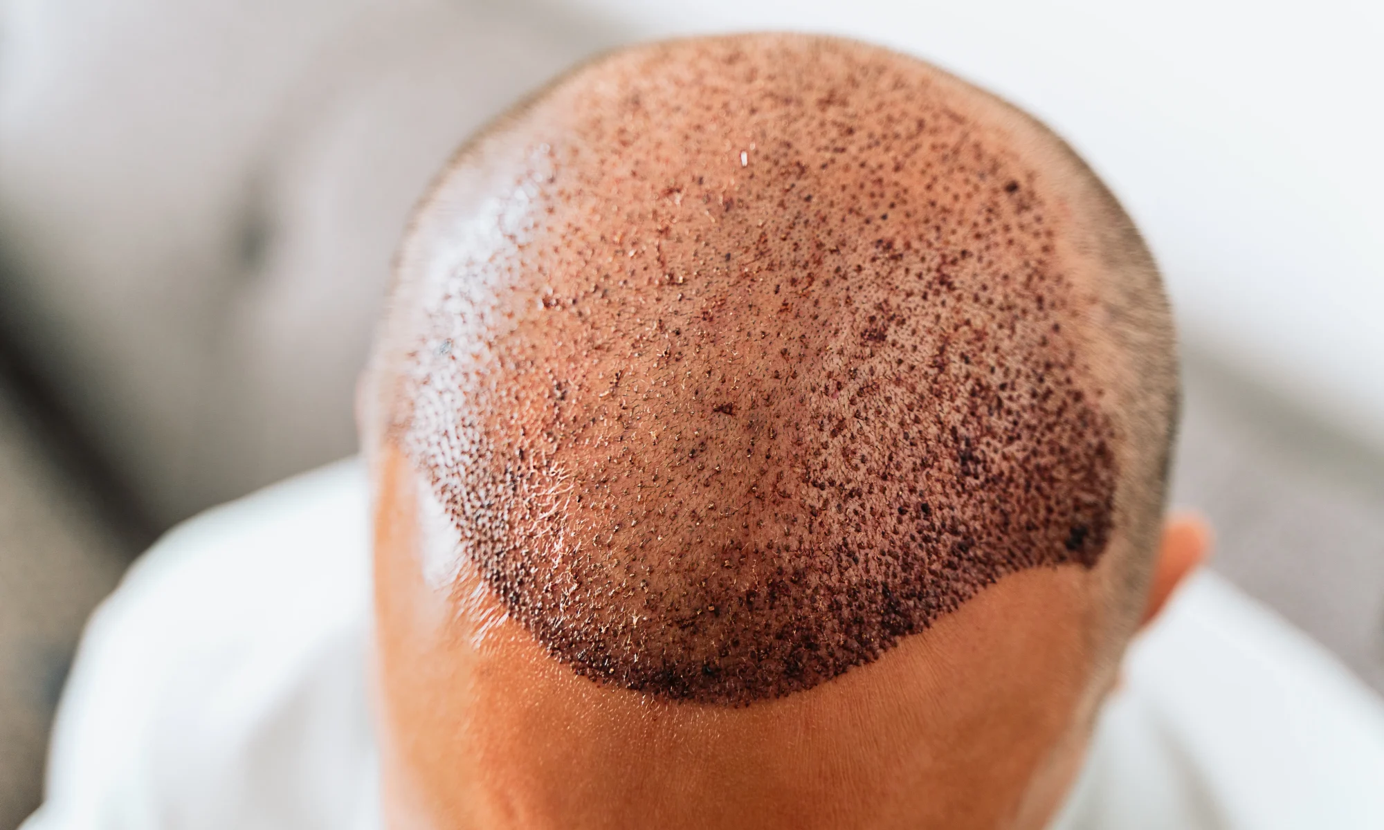 Top view of a patient scalp showing scabbed grafts after the best hair transplant Mexico procedure.