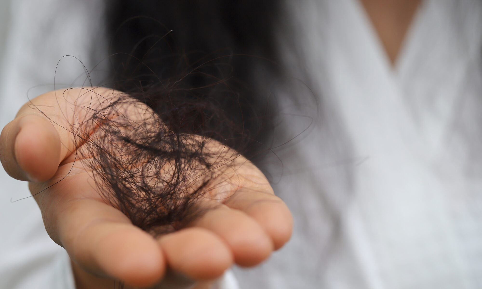 A person holding a large clump of fallen hair in their open palm, showing symptoms of a severe hair loss disease.