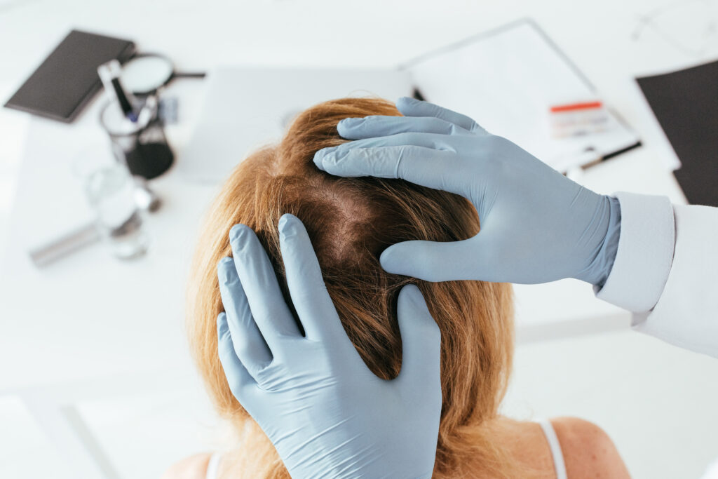Back view of a man's head split to compare a healthy side with a side suffering from a visible hair loss disease.