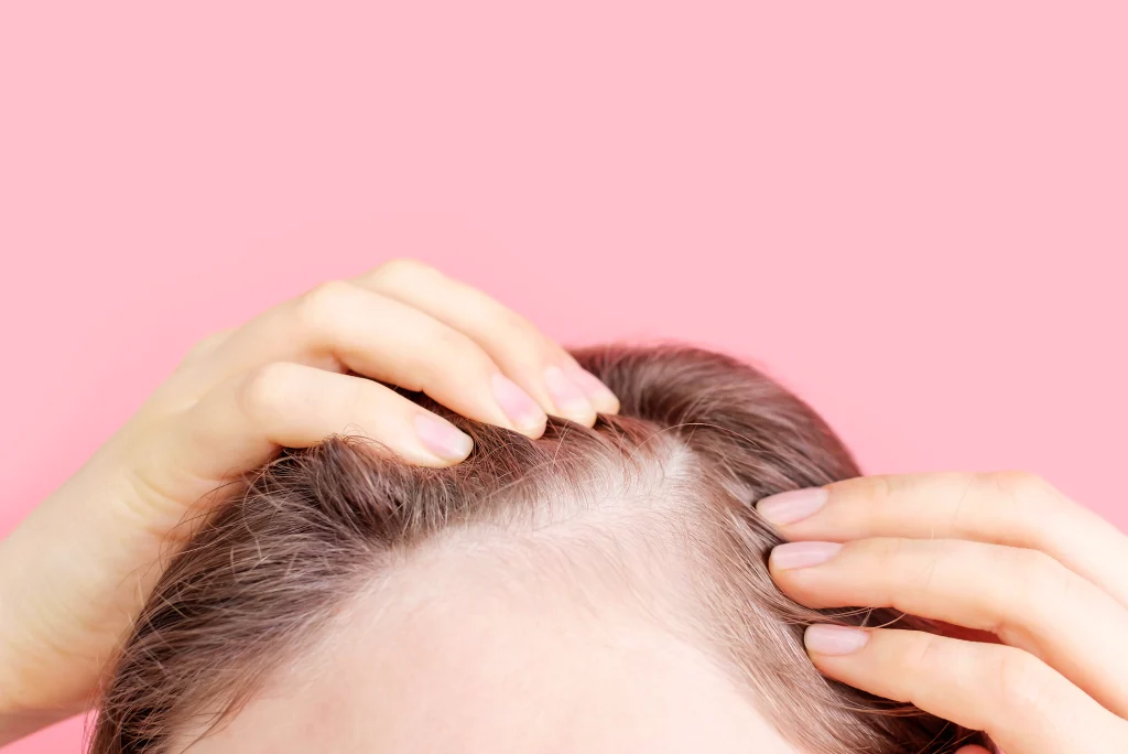Extreme close-up of a human scalp with noticeably thinning dark hair strands due to a chronic hair loss disease.