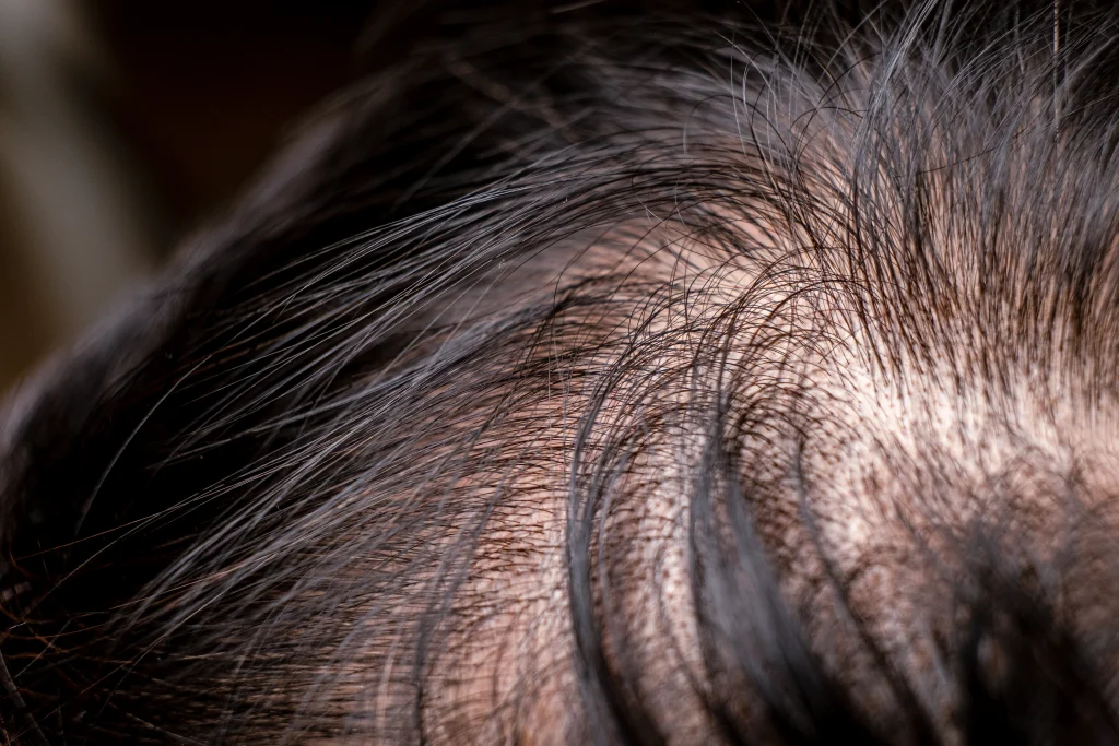 A woman parting her hair against a pink background, checking her scalp for signs of a progressive hair loss disease.