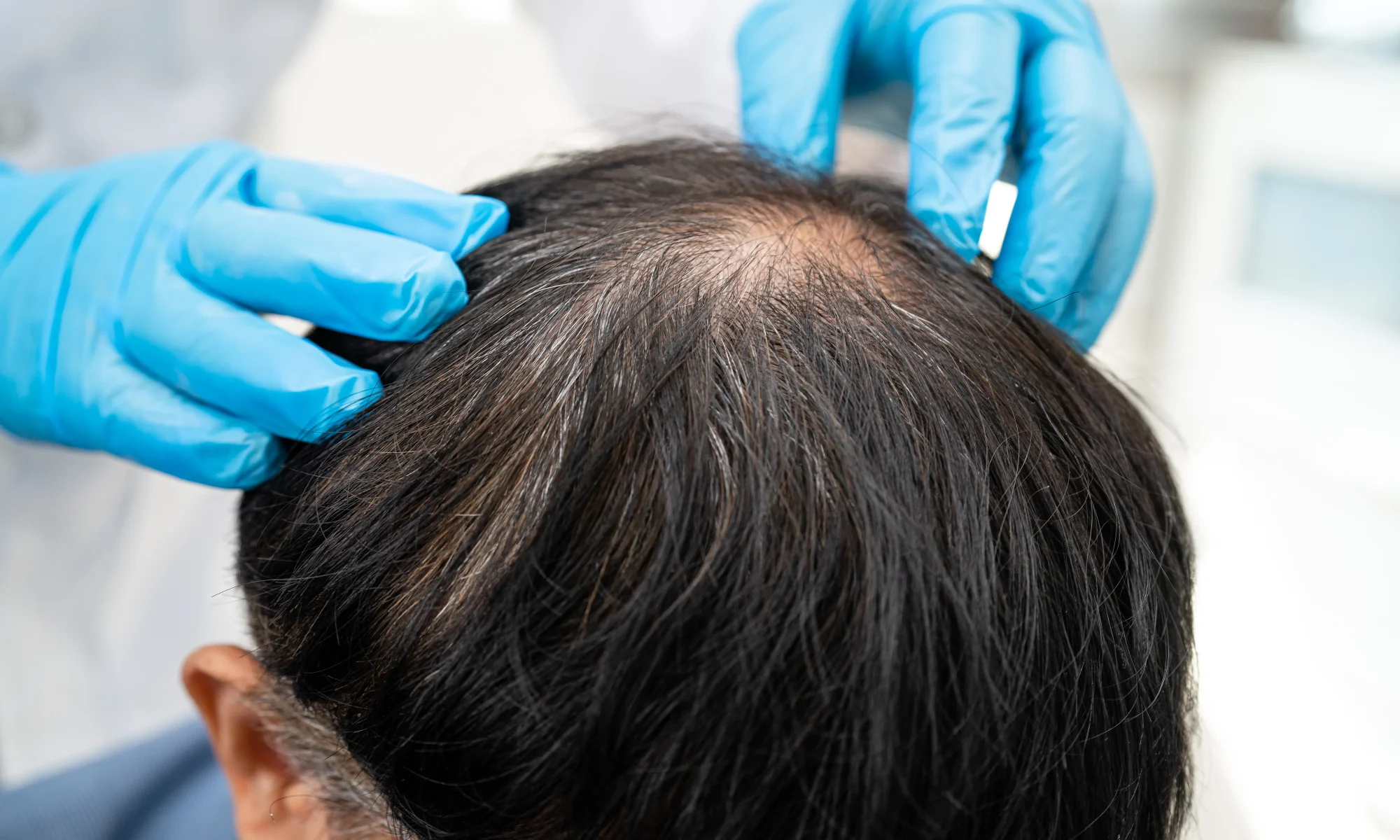Doctor examining a man's crown area for signs of hair loss during a routine professional scalp evaluation.