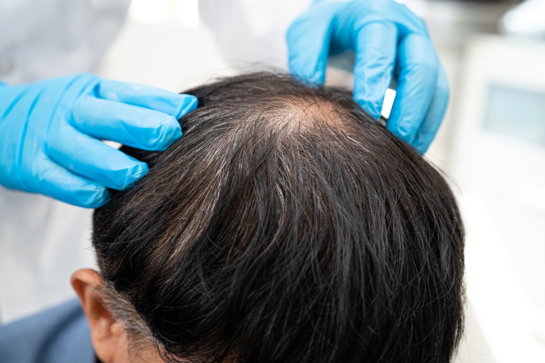 Gloved hands examine a thinning scalp, preparing for an effective exosomes treatment procedure.