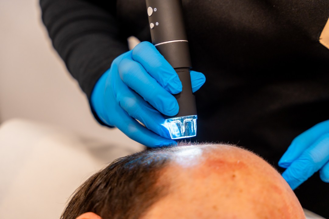 Close-up: a gloved specialist applies a precise laser-guided exosomes treatment to a patient's scalp.