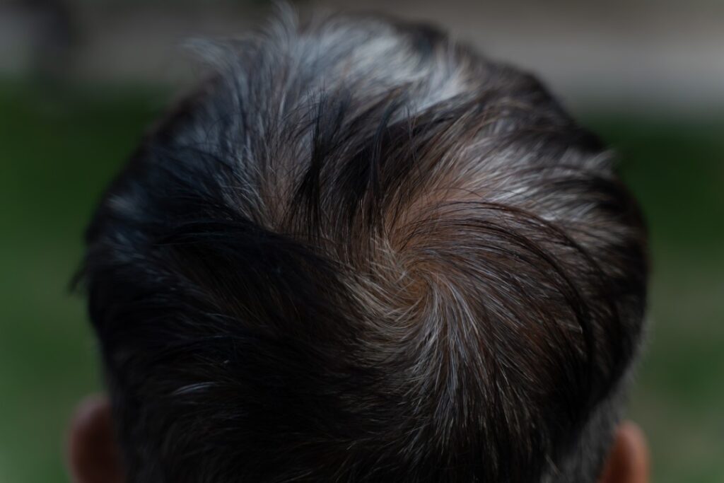 Overhead view of a man's thinning crown before beginning a restorative exosomes treatment plan.