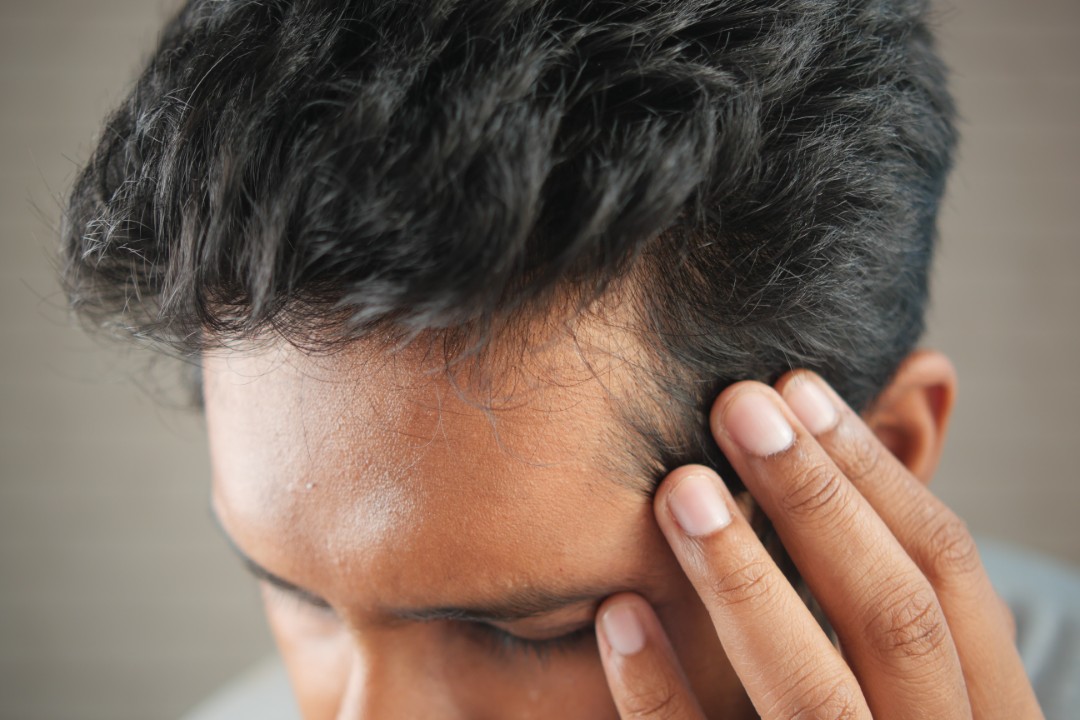 A man examines his thinning hairline, a common starting point in exploring exosomes vs PRP for hair loss.