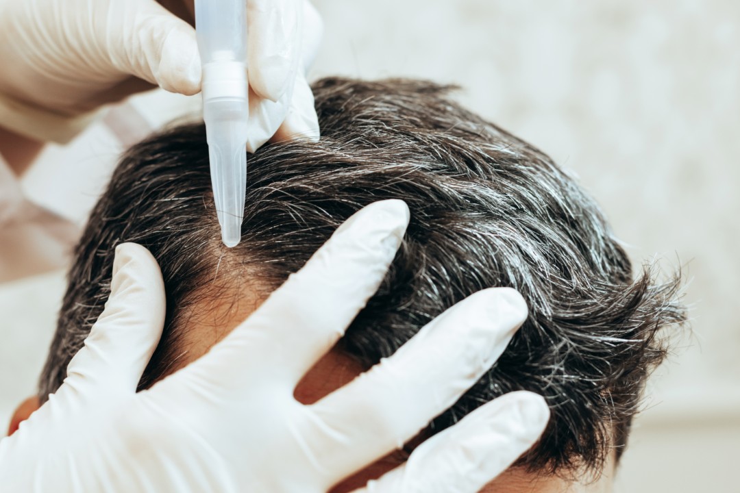 Close-up of a mesotherapy scalp treatment, applying hair growth peptides via injection to stimulate follicles.