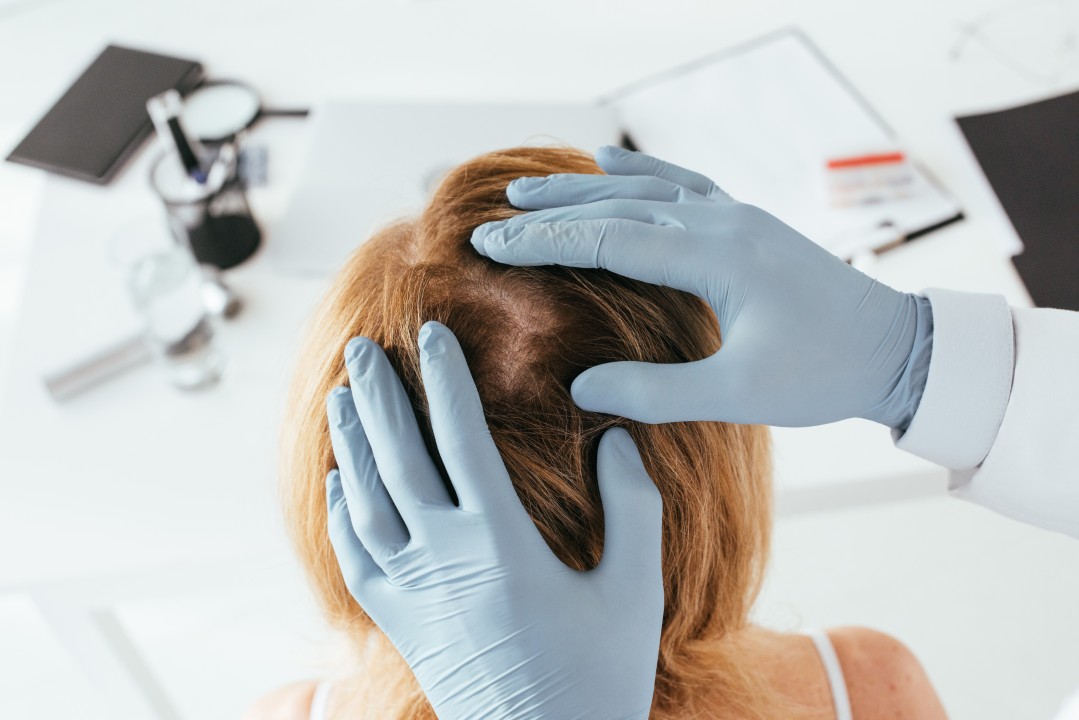 Trichologist, maybe discussing hair growth peptides, examining a patient's blonde hair and scalp with gloved hands.