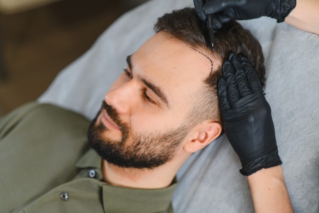 Patient's hairline marked before surgery at a hair transplant clinic.