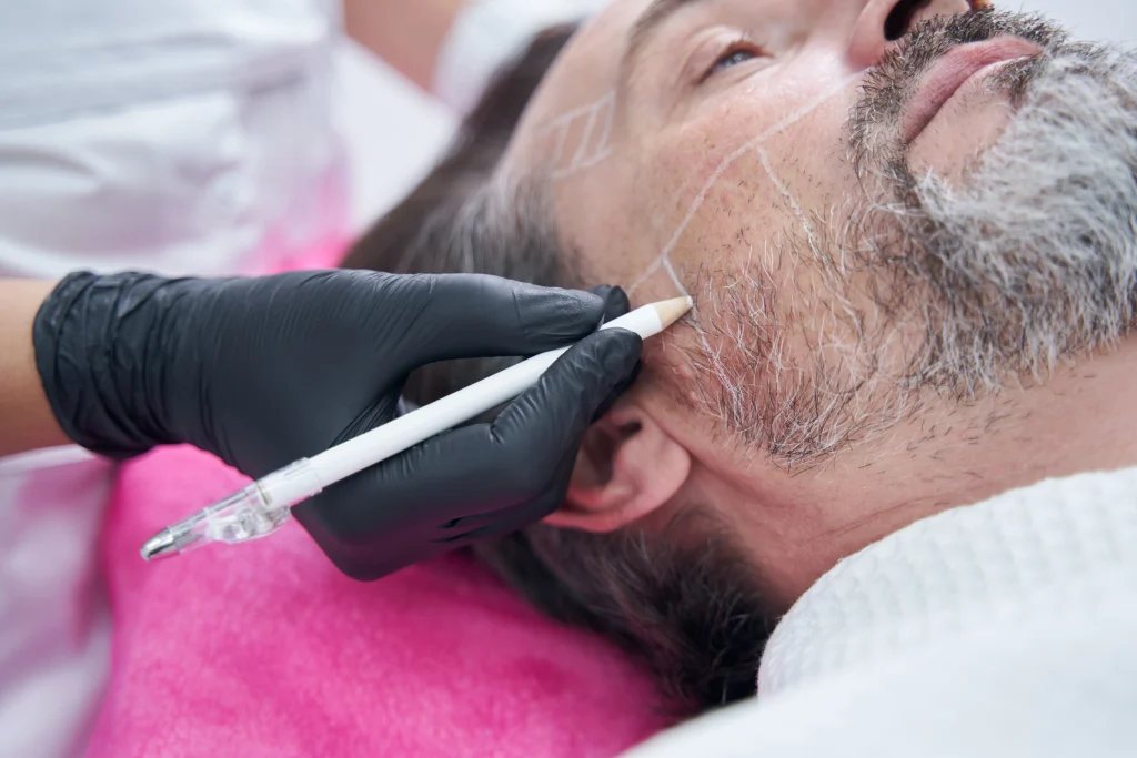 Specialist drawing surgical lines on a patient's face to plan facial hair density and beard transplant cost in Mexico.