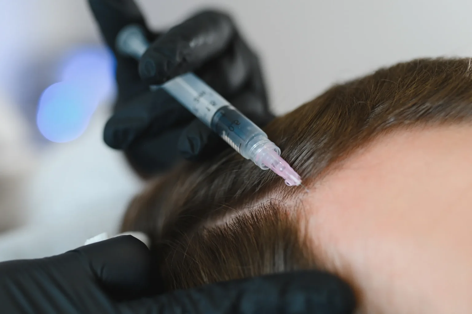 PRP After Hair Transplant: Is It Worth Considering?
