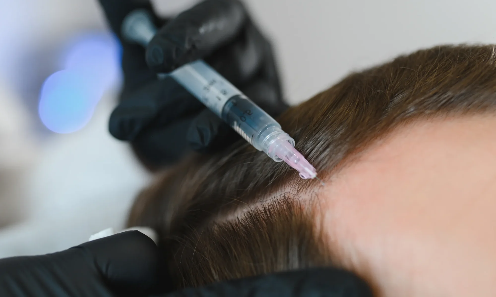 PRP after hair transplant procedure with black gloved specialist injecting the scalp.