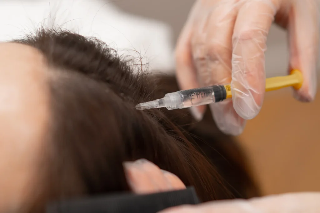PRP after hair transplant treatment with a close-up injection into dark hair scalp.