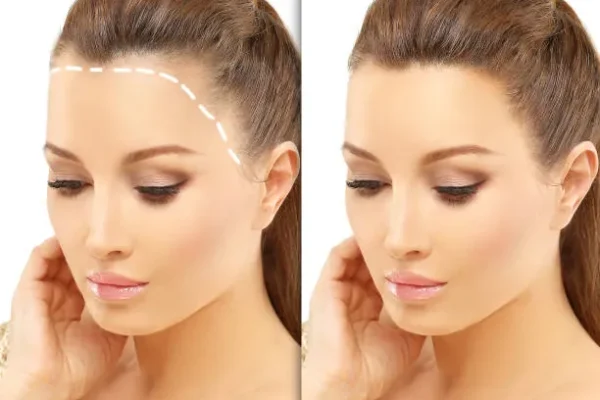 Side-by-side comparison showing a woman’s frontal hairline visibly fuller after undergoing a traditional FUT hair transplant procedure.