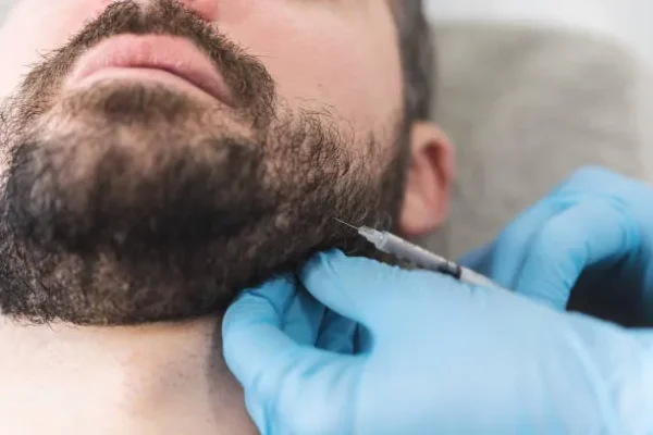 Beard being treated with a series of injections to stimulate natural growth and density through a modern facial hair transplant approach.