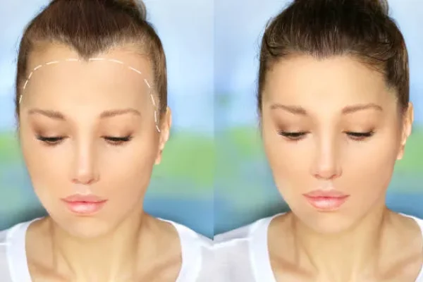Dramatic change in hairline density shown in a woman who had sparse frontal hair before getting a FUT hair transplant.