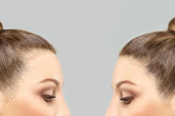 Enhanced frontal appearance in a female patient with fine hair, following a FUT hair transplant focused on frontal and temporal regions.