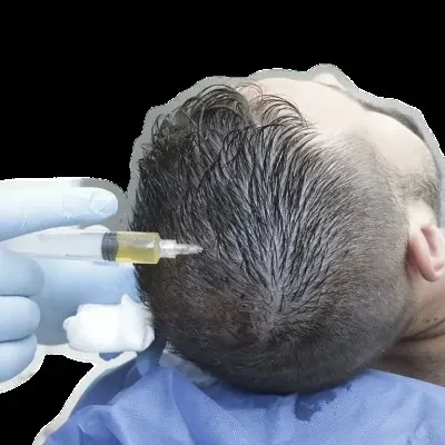 Inyección de PRP en la cabeza del paciente por un profesional, un tratamiento no quirúrgico popular para la caída del pelo.