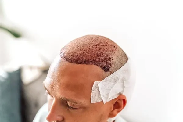 Hair botox: técnica quirúrgica avanzada después de un trasplante capilar que reposiciona folículos capilares en cuero cabelludo calvo vendado.