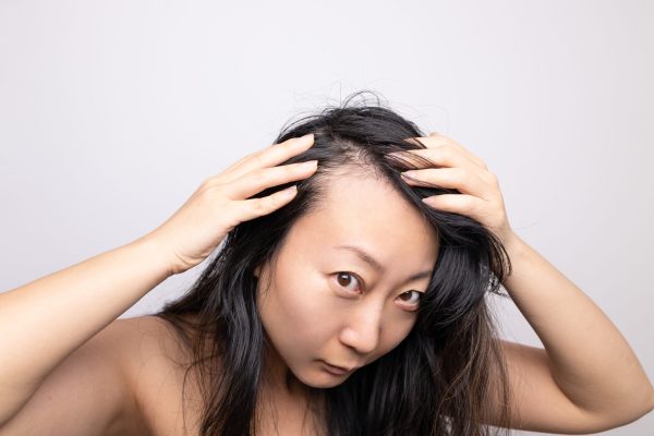 Woman experiencing significant hair thinning across her scalp options. Can you change your hair texture with a hair transplant?