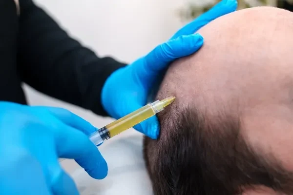 Hair botox: terapia innovadora de inyección PRP con precisión para regeneración y fortalecimiento del cabello en cuero cabelludo.
