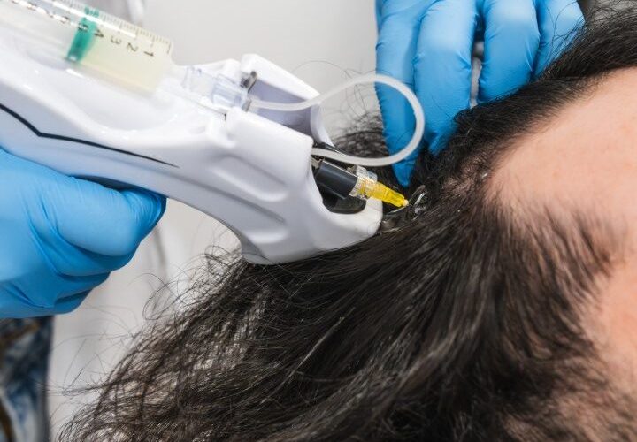 Un médico inyectando stem cell therapy for hair loss en el cuero cabelludo de un paciente.